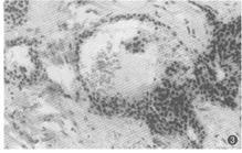 “綠色療法”防癌細(xì)胞轉(zhuǎn)移復(fù)發(fā)